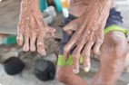 A photo of leprous hands