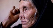 A photo of woman with leprosy