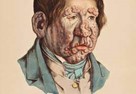 A drawing of a man with leprosy