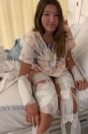 Lady bandaged with box jellyfish injuries